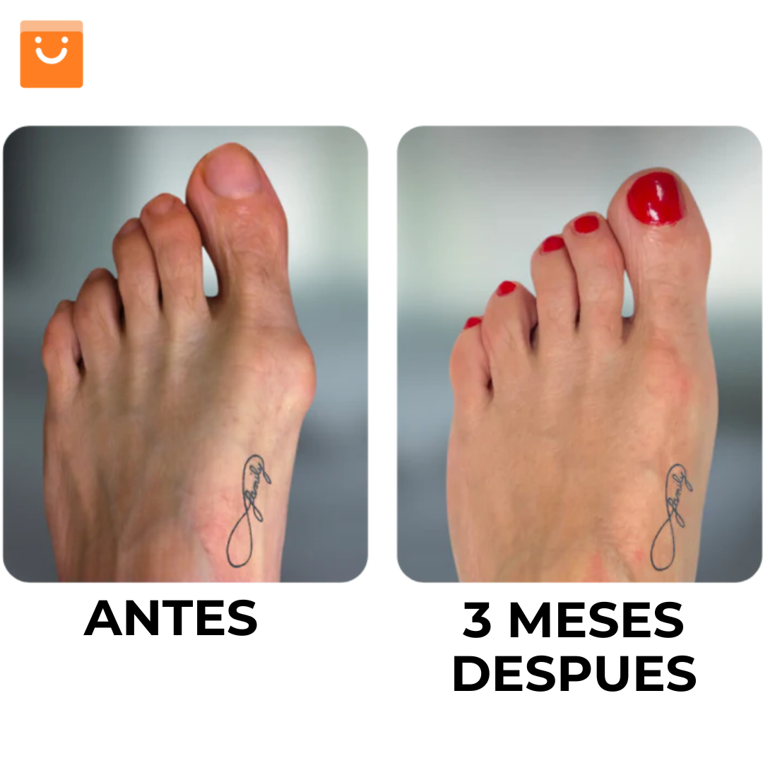 HALLUXCARE™ - CORRECTOR DE JUANETES