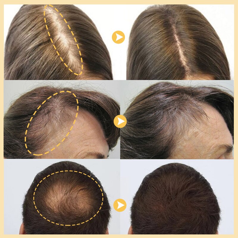 Purc™ - Aceite esencial para el crecimiento del cabello